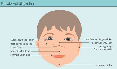 Beispiele für typische Gesichtszüge bei Fetalem Alkoholsyndrom: kurze Lidspalten, verstrichenes Philtrum, schmale Oberlippe.