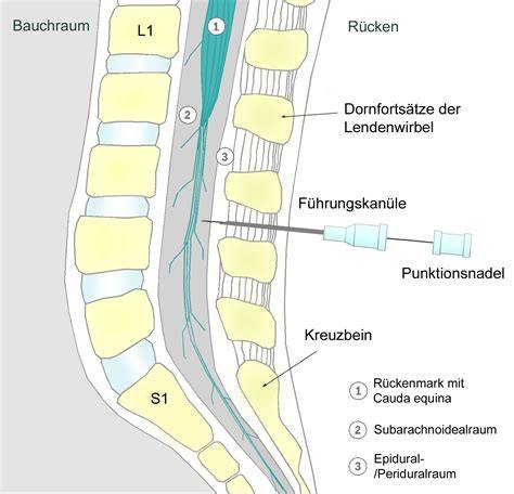 Schema der Spinalanästhesie bei einem Kaiserschnitt