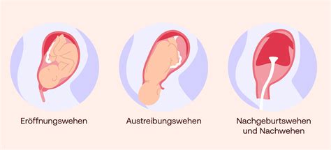 Illustration von Geburtswehen und platzender Fruchtblase
