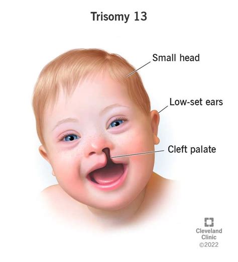 Abbildung eines Säuglings mit typischen Merkmalen der Trisomie 13: z.B. Lippen-Kiefer-Gaumenspalte, kleine Augen, Polydaktylie
