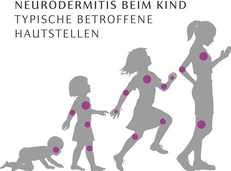 Illustration, die die richtige Technik des Eincremens eines Babys mit Neurodermitis zeigt