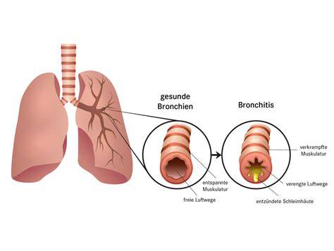 Schema der Atemwege, das eine Verengung der Bronchien bei Bronchitis zeigt.