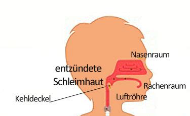 Illustration eines Kindes mit Pseudokrupp, das bellend hustet und Atemnot hat.
