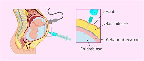 Schema: Ablauf einer Amniozentese und NIPT-Test