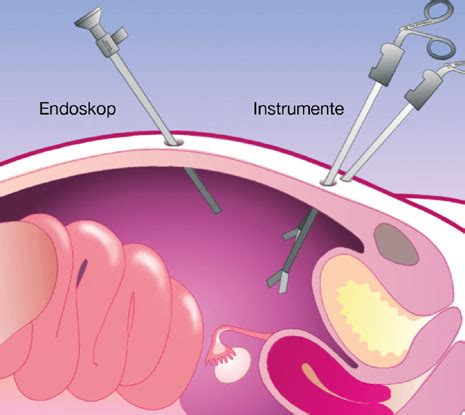 Schematische Darstellung der Laparoskopie mit Einführung von Trokaren und Kamera in den Bauchraum