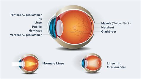 Grafik, die den Unterschied zwischen einer normalen und einer verkrümmten Hornhaut zeigt