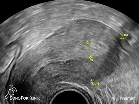 Darstellung eines transvaginalen Ultraschalls der Gebärmutter mit Messung der Endometriumdicke