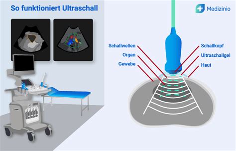 Schema einer Ultraschalluntersuchung des Hodensacks zur Diagnosefindung.