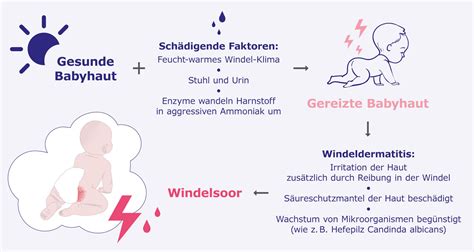 Schema der Entstehung von Windeldermatitis durch Feuchtigkeit, Reibung und chemische Reizung