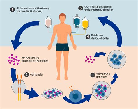 Schematische Darstellung der verschiedenen Therapieansätze bei Neuroblastomen (Operation, Chemotherapie, Strahlentherapie, Immuntherapie).