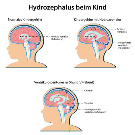 Illustration des Gehirns mit Darstellung eines Hydrozephalus und eines Liquorshunts.