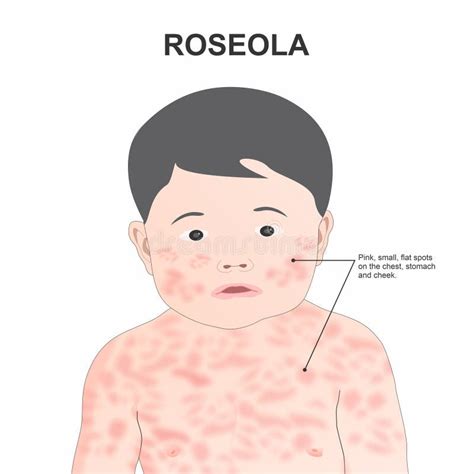 Illustration eines Kindes mit Hautausschlag, der durch alltägliche Gegenstände ausgelöst wird.