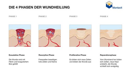 Grafik zur Darstellung der verschiedenen Phasen der Wundheilung einer Kaiserschnittnarbe