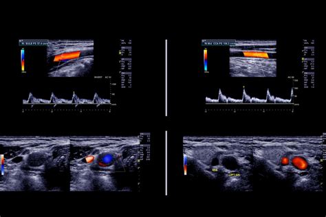 Ultraschallbilder (Querschnitte) von gesunden und entzündlich veränderten Gebärmutterhörnern