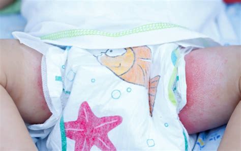 Darstellung der verschiedenen Erscheinungsformen von Windelausschlag bei Babys, je nach Ursache und Hautton (gerötete Stellen, Pickelchen, schuppige Haut, nässende Wunden)