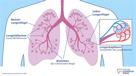 Eine schematische Darstellung der Lunge, die gesunde Lungenbläschen und die Veränderungen bei Bronchopulmonaler Dysplasie zeigt.