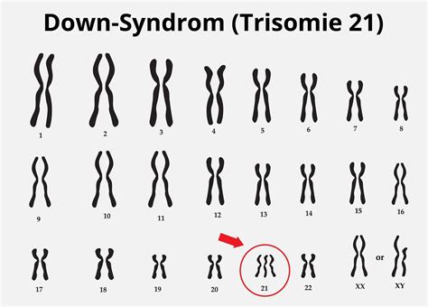 Symbolbild für Chromosomen, die eine Trisomie 21 darstellen