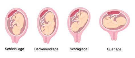 Grafik, die verschiedene Kindslagen in der Gebärmutter zeigt (Schädellage, Beckenendlage, Querlage, Schräglage)