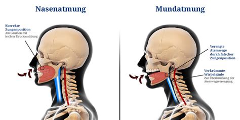 Grafik, die die Auswirkungen des Schnullers auf die Zungenposition und Mundatmung zeigt