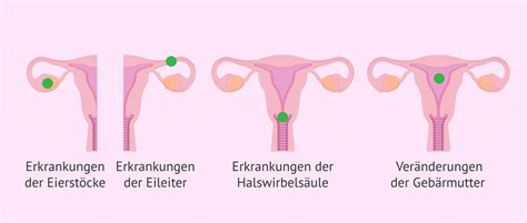 Diagramm, das die verschiedenen Ursachen weiblicher Unfruchtbarkeit veranschaulicht.