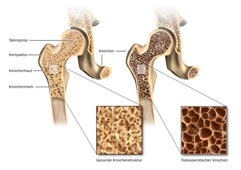Schema der Knochenstruktur und der Auswirkungen von Osteoporose