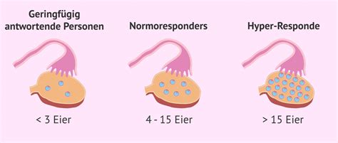 Schema des IVF-Ablaufs mit Stimulation der Eierstöcke