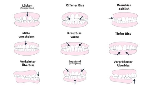 Illustration, die verschiedene Arten von Zahnfehlstellungen zeigt (Überbiss, Kreuzbiss, offener Biss).