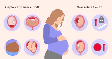 Schema zur Narbenbildung nach einem Kaiserschnitt und mögliche psychische Auswirkungen