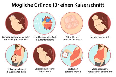 Infografik: Gründe für einen Kaiserschnitt - medizinisch notwendig vs. Wunschkaiserschnitt