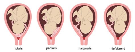 Schema der Gebärmutter mit normal liegender Plazenta und verschiedenen Formen der Plazenta praevia (totalis, partialis, marginalis)