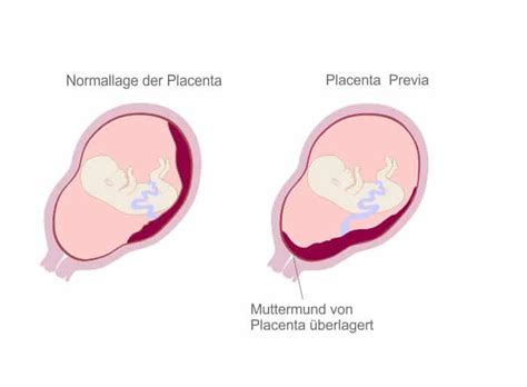 Grafik, die die Wahrscheinlichkeit des Verschiebens einer Plazenta praevia im Verlauf der Schwangerschaft zeigt