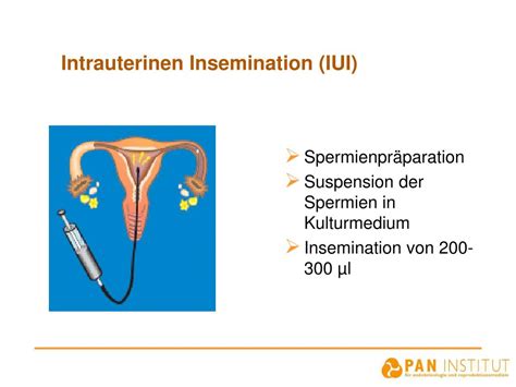 Schema der intrauterinen Insemination (IUI)