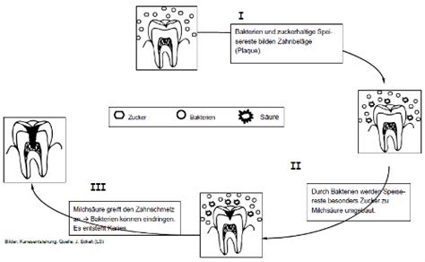 Illustration, die die Entstehung von Karies durch zuckerhaltige Getränke am Beispiel von Milchzähnen zeigt