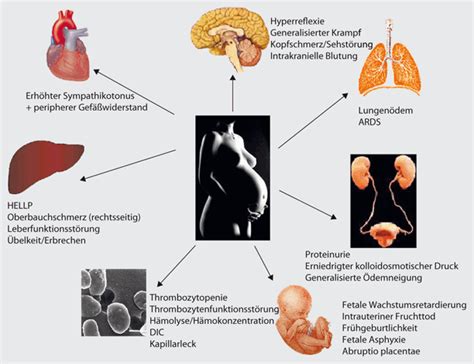 Flussdiagramm zur Diagnostik und Behandlung von Präeklampsie, HELLP-Syndrom und Eklampsie