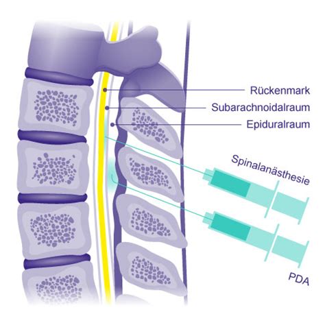 Schema des Epiduralraums und der Platzierung des PDA-Katheters