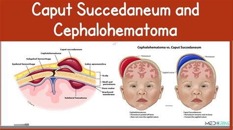 Schematische Darstellung eines Kephalhämatoms im Vergleich zu einer Geburtsgeschwulst (Caput succedaneum)