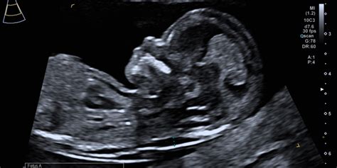 Übersicht über pränatale Diagnoseverfahren für Trisomie 21
