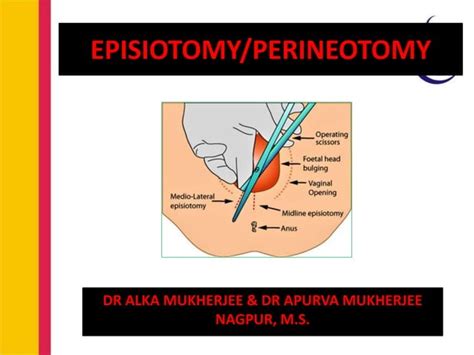 Illustration einer Episiotomie (Dammschnitt)